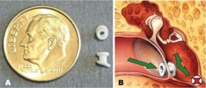 Should my child get ear tubes?
