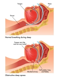 Obstructive Sleep Apnea Austin, TX