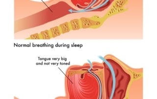 Obstructive Sleep Apnea Austin, TX