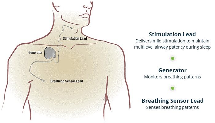 Inspire Sleep Apnea Therapy