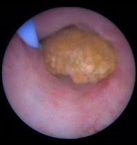 Example of the endoscopic appearance of a stone