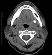 Example of the CT scan appearance of a stone