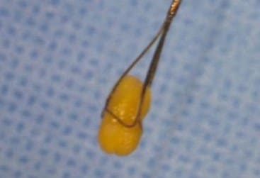 Sialendoscopy4 Sialendoscopy
