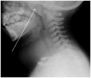 adenoid removal