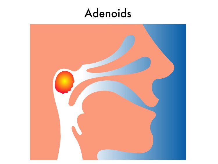 Adenoid Removal Austin