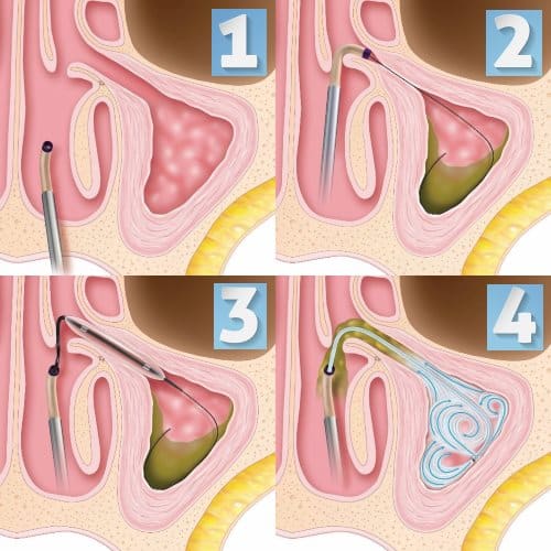 Balloon Sinuplasty Austin