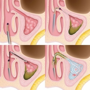 Balloon Sinuplasty